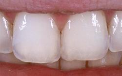 nach der Behandlung ist die natürliche Zahnstruktur wieder hergestellt